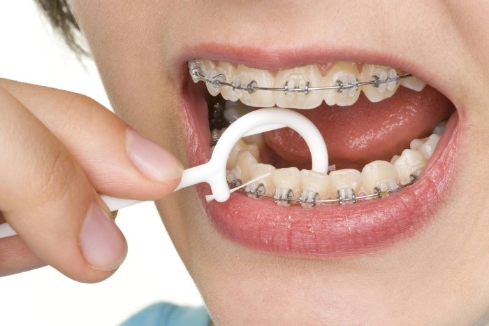 how to use dental floss with braces