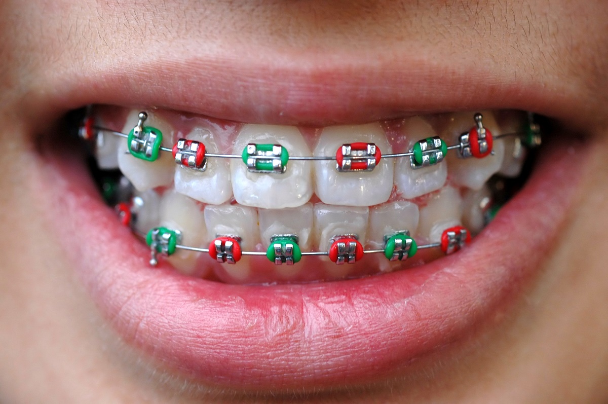 red braces for teeth